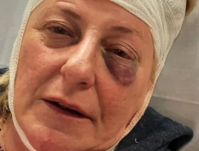 “Lesbica di m…”: 50enne aggredita con calci e pugni nel quartiere Cristo